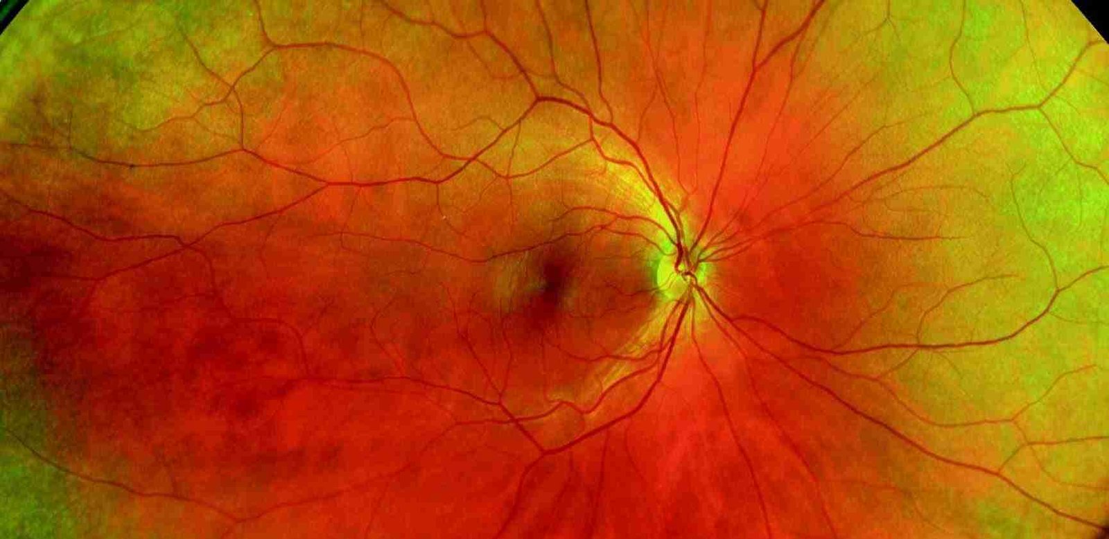 Optos Widefield Imaging – A Case Study